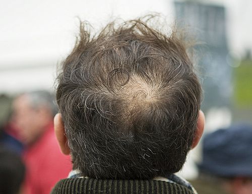 Autunno, capelli in caduta? Tutto normale ma…