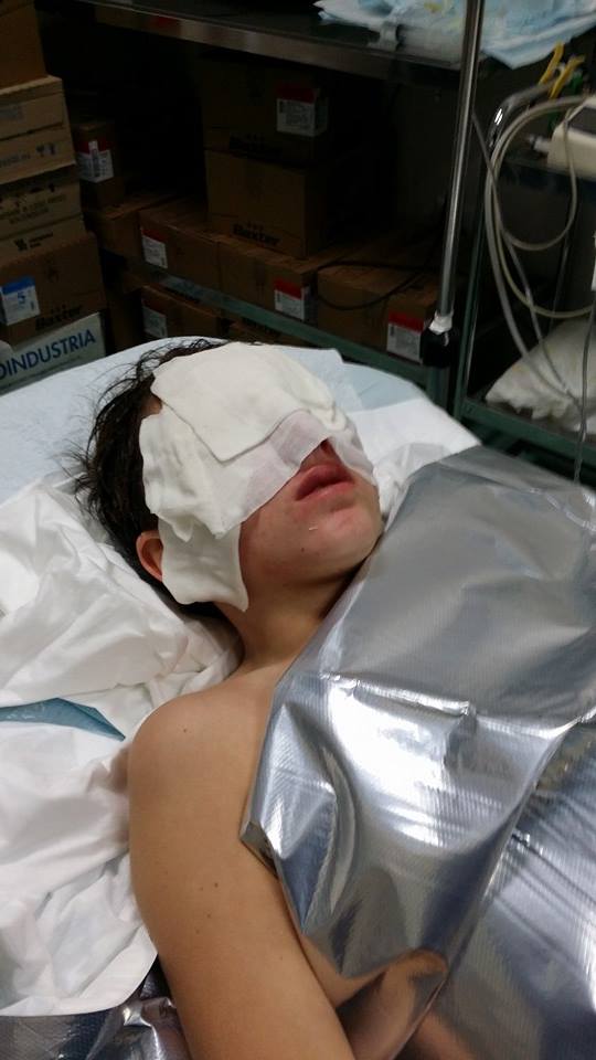 Fiumefreddo, 13enne ferito al volto da gravi ustioni per un petardo lanciato da un gruppo di balordi