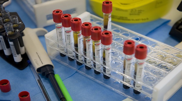 Mascali, caso sospetto meningite, in corso le analisi microbiologiche