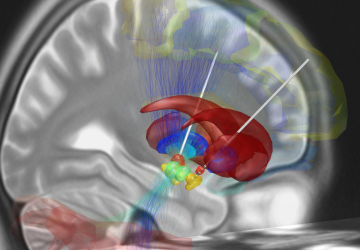 Clinica Villa Mafalda e la neurochirurgia di precisione
