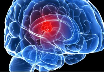 Tumore al cervello curato con il bicarbonato: medico radiato e condannato a 5 anni