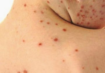 Epidemia di morbillo: interventi per il contenimento dei casi in Provincia di Catania