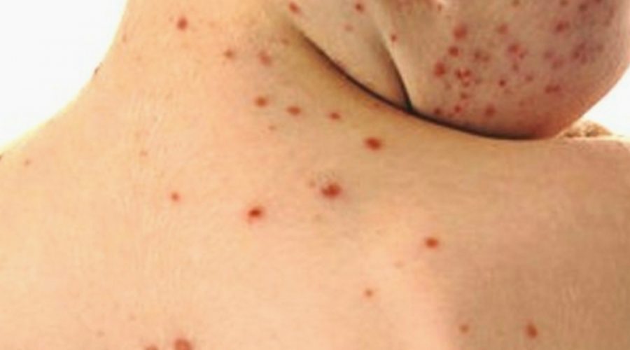 Epidemia di morbillo: interventi per il contenimento dei casi in Provincia di Catania