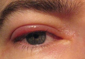 Orzaiolo: cause, sintomi e rimedi