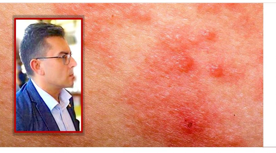 A Francavilla di Sicilia è &quot;allarme scabbia&quot; le rassicurazioni del