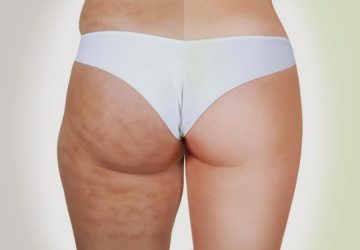 5 consigli per combattere la cellulite efficacemente