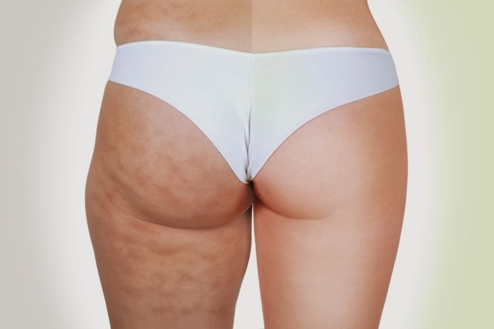 5 consigli per combattere la cellulite efficacemente