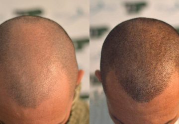 Alopecia? La tricopigmentazione può essere la soluzione