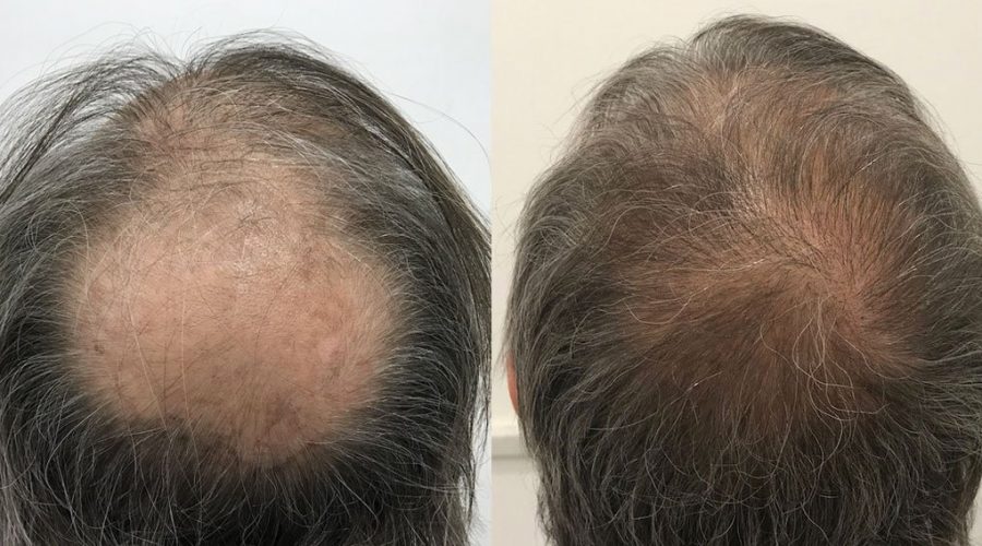 Hai bisogno di un trapianto di capelli? Ecco cosa scegliere tra FUT e FUE