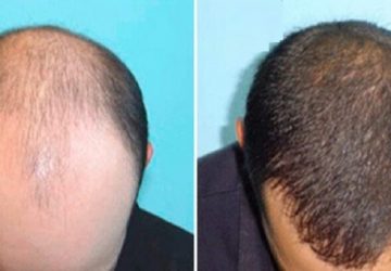 Trapianto di capelli in Turchia: tutti i benefici dei rivoluzionari sistemi chirurgici