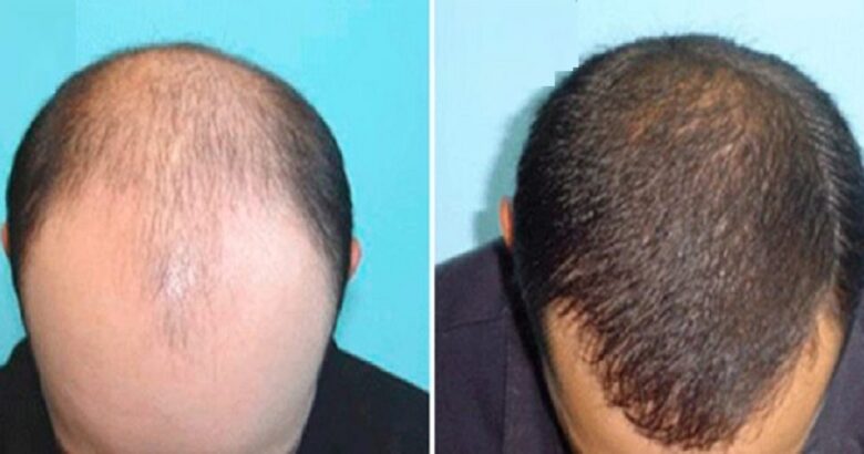 Trapianto Di Capelli In Turchia Tutti I Benefici Dei Rivoluzionari Sistemi Chirurgici