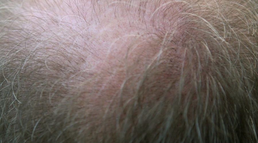 Le nuove frontiere del trapianto di capelli