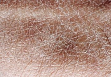 Pelle secca: come risolvere questo problema