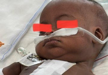 Dal Burundi a Taormina: la piccola Shama salvata dai medici del reparto di cardiochirurgia pediatrica